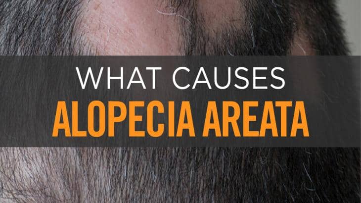 Alopecia Areata