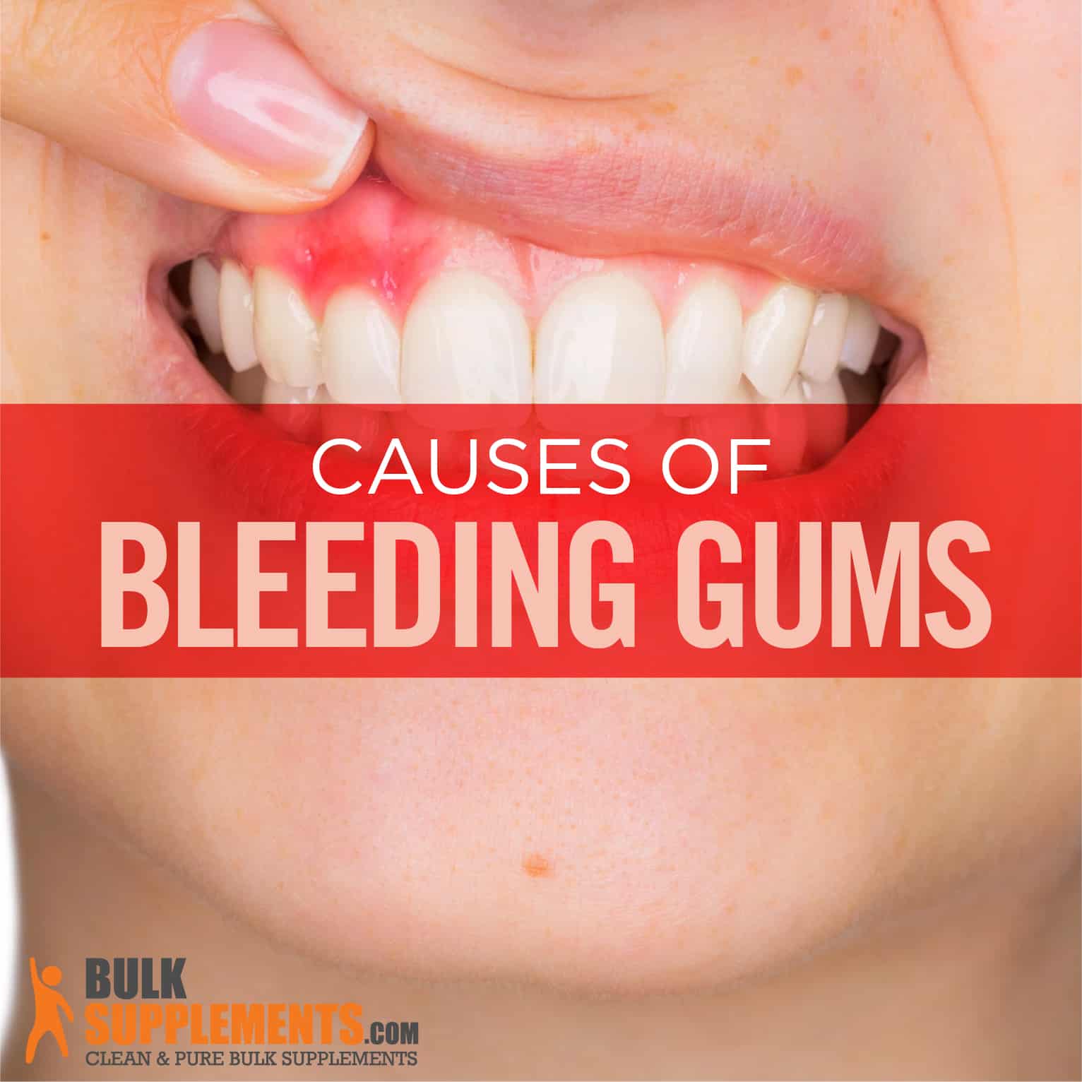 Bleeding Gums Characteristics Causes Treatment