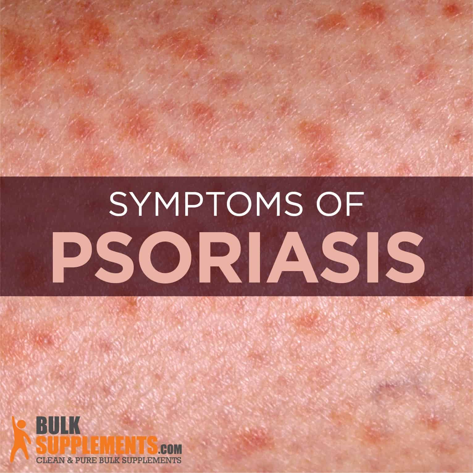 Psoriasis Causes Symptoms And Treatment