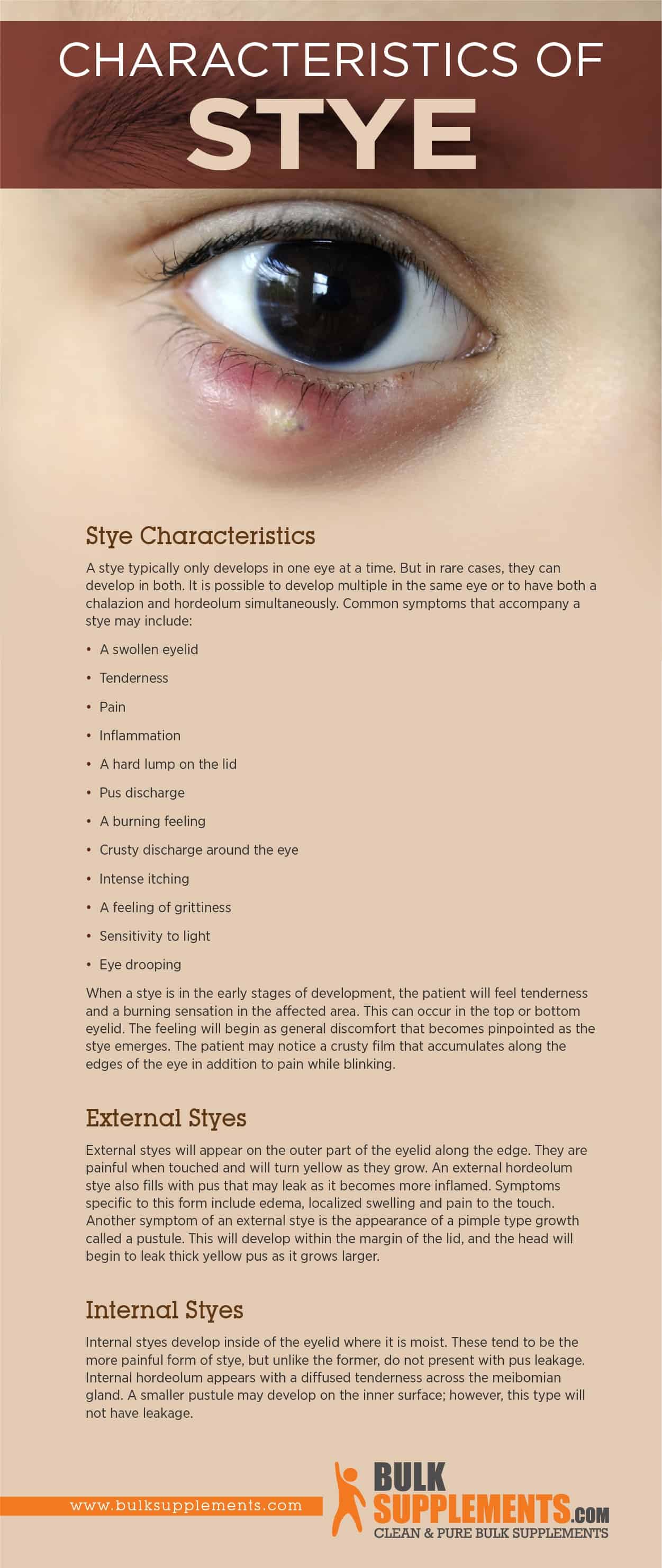 Stye Characteristics