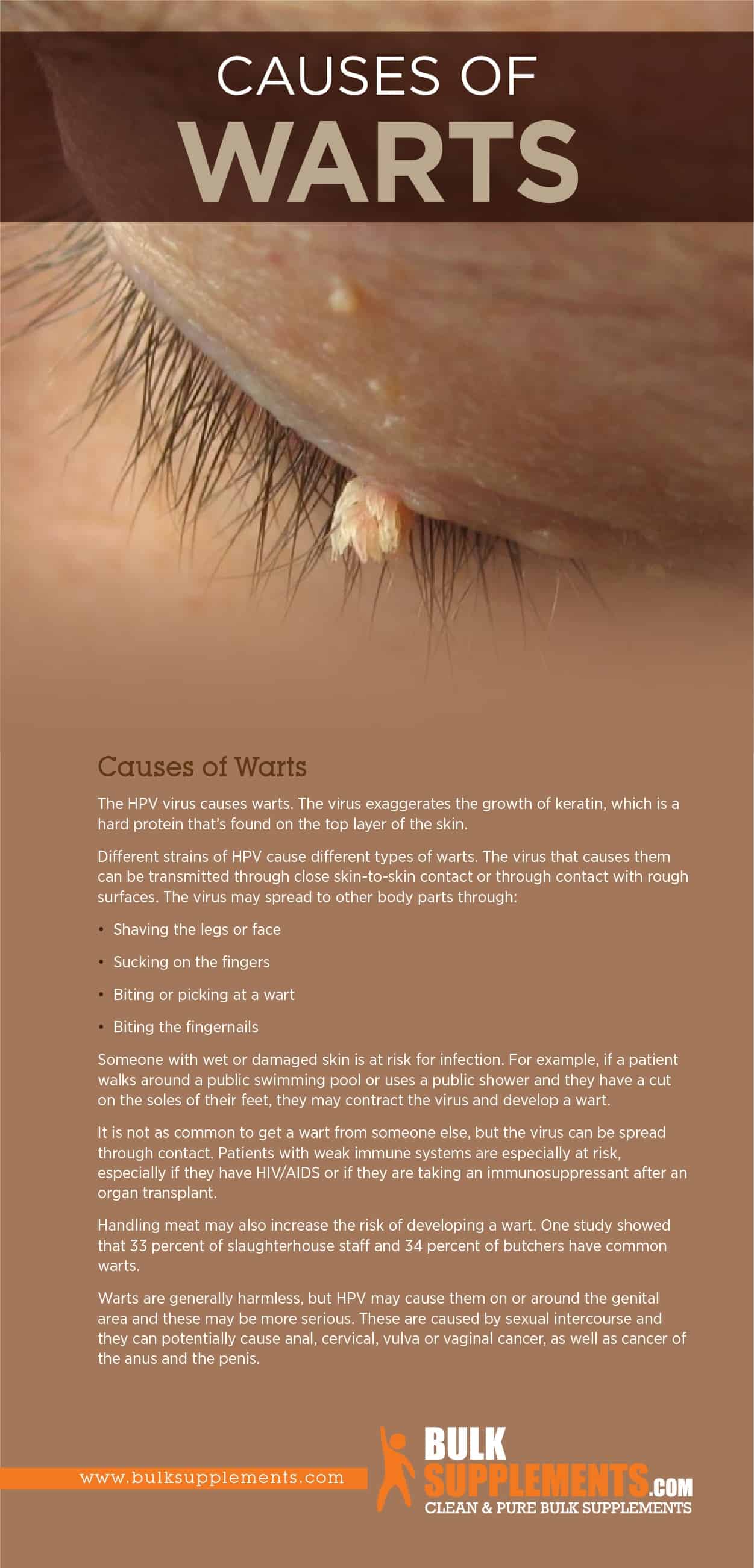 Causes of Warts