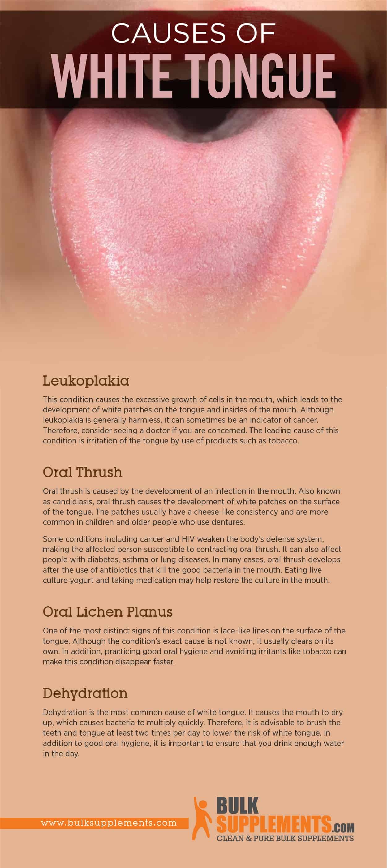 Causes of White Tongue