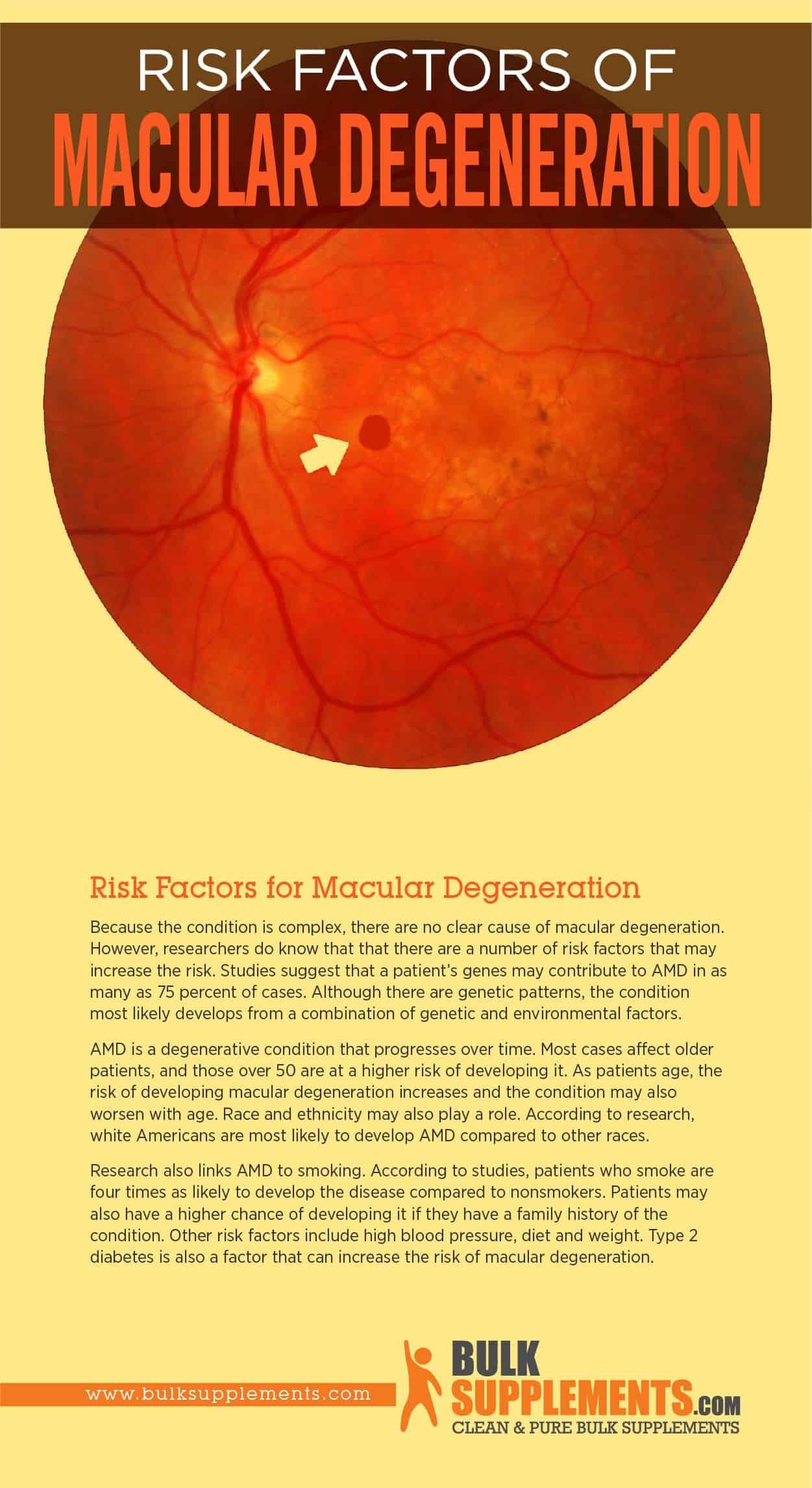Risk Factors of Macular Degeneration