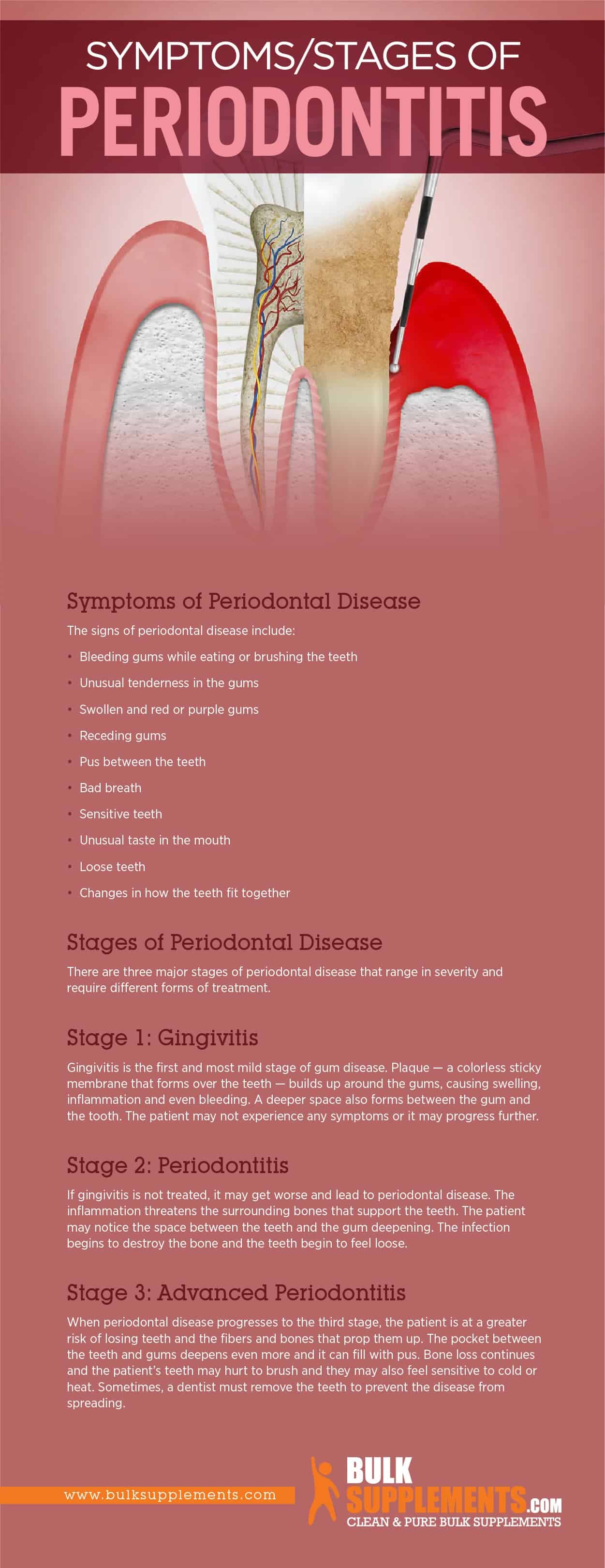 Symptoms/Stages of Periodontal Disease